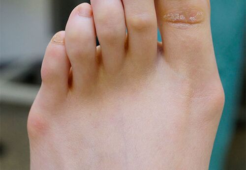 Valgus foot