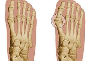 causes of hallux valgus