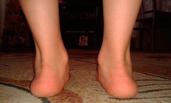 Valgus flat feet