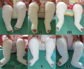 Casting procedures, each modifying the position of the foot