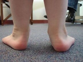 Flat foot valgus deformity in a child