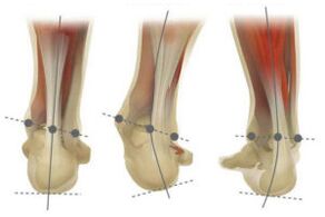 Normal foot, with valgus and varus deviation of the calcaneus