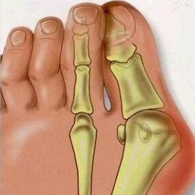 Valgus reasons