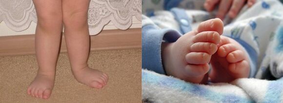 Foot valgus deformation