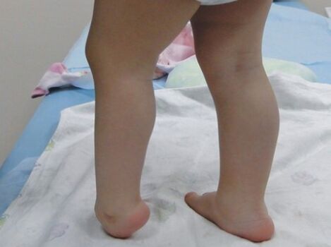 The first symptoms of the foot valgus of the foot