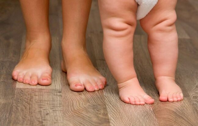 Foot valgus deformation in children