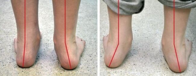 Valgus foot