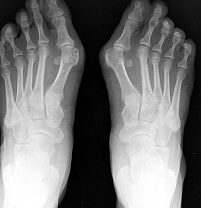 X-ray of the foot